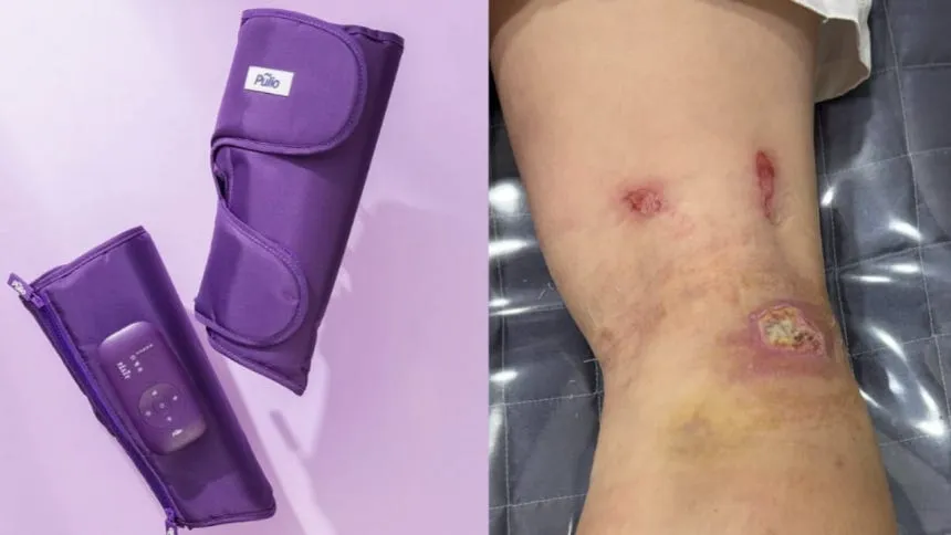 “저온 화상으로 흉터 생겨” 치료비 요구했지만...풀리오 “보상 못해” 갈등 이미지